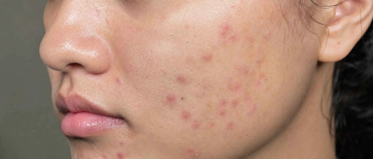 An image of acne-prone skin
